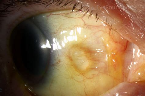 Atlas Entry Conjunctival Epithelial Inclusion Cyst