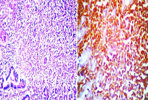 A Gastric Large B Cell Lymphoma H And E X200 B Gastric Large