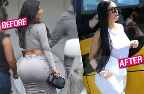 kim kardashian butt implants removed claim top plastic surgeons