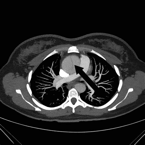 Cureus Ascending Aortic Aneurysm With Dissection In The Second