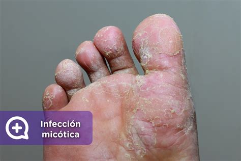 Micosis Superficiales Y Cutaneas Piel Enfermedades Y Trastornos Images