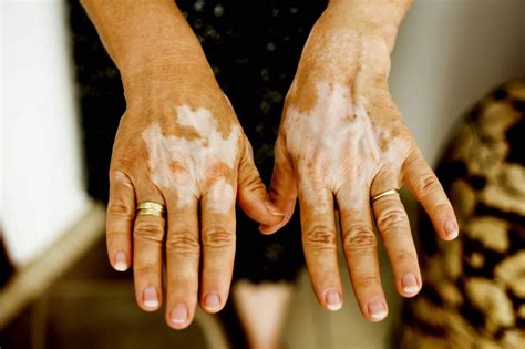 Vitiligo Causes Treatments And Coping Strategies Skin And Cancer