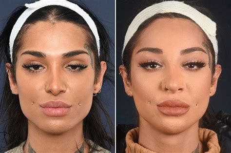 Jaw Reduction Feminizing The Jaw Pass Clinic