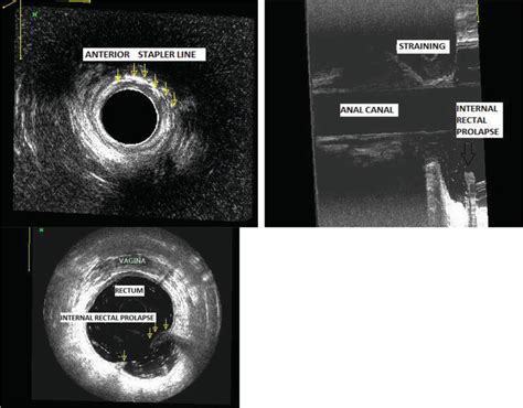 The Role Of Three Dimensional Endoanal Ultrasound In Preoperative