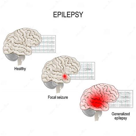 Epilepsie Eeg Des Gesunden Gehirns Und Des Epileptischen Anfalls Vektor