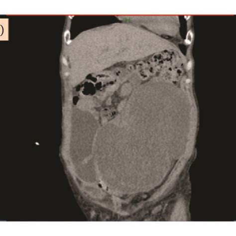 A Large Tumor Occupying The Abdominal Cavity On A Computerized