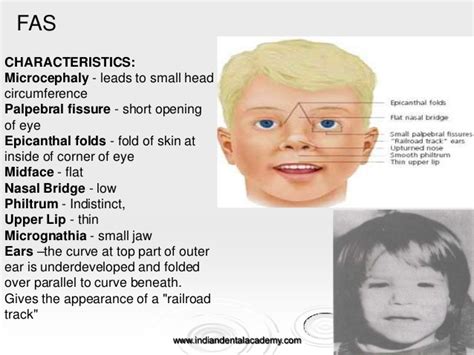 Medical conditions that cause the nasal bridge not to develop and project are also associated with epicanthic fold. Prenatal growth & development /diploma orthodontic course ...