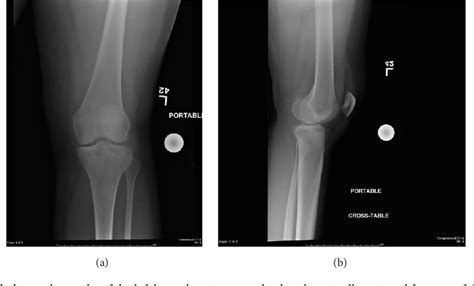 Nondisplaced Tibial Plateau Fracture Recovery