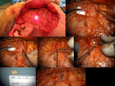 Complication From Open Parotid Ductoplasty For Stone With Parotid