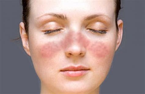 The 10 Symptoms That Mean You May Have Lupus Lifedaily
