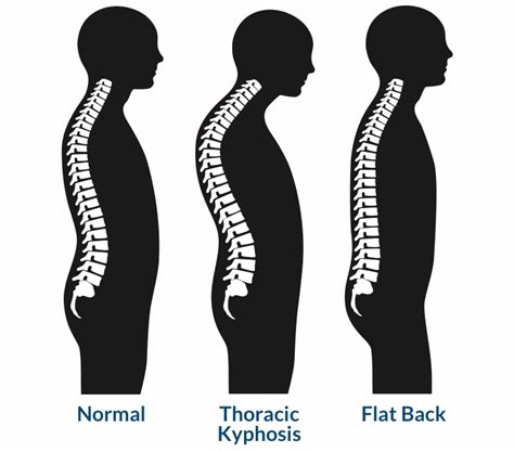일자허리flat Back Syndrome 추나요법으로 체형 교정 네이버 블로그