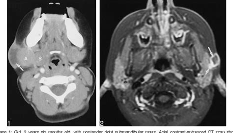 Figure 1 From Nontuberculous Mycobacterial Infection Of The Head And