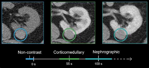 Abdominal Ct Gu Imaging Litfl Radiology Library