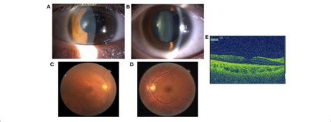 A Slit Lamp Examination Showing Improvement Of The Corneal