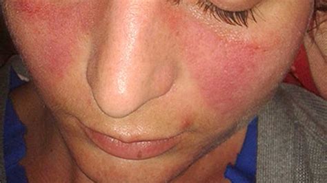 Rash And Swollen Lymph Nodes Causes Photos And Treatment