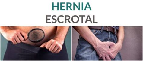 hernia escrotal definición causas síntomas diagnóstico tratamiento y recomendaciones