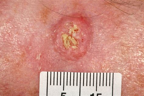 Non Melanoma Skin Cancers