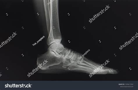 Lateral Radiograph Xray Foot Ankle Showing Stock Photo 1335617252