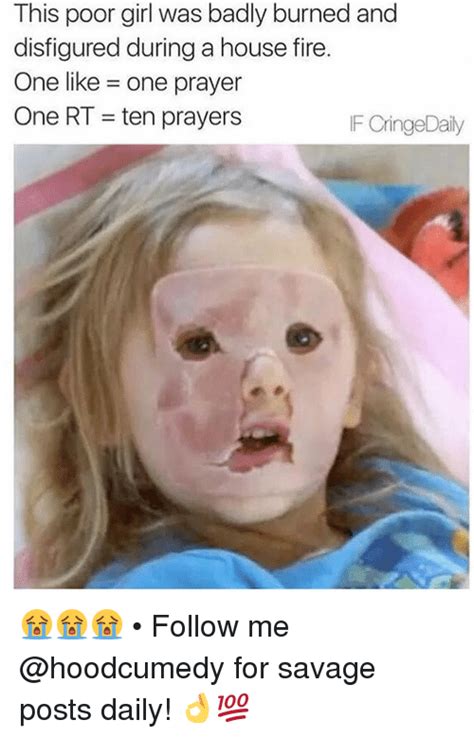 This Poor Girl Was Badly Burned And Disfigured During A