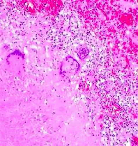 Case Report Tuberculosis Lymphadenitis With F1000research