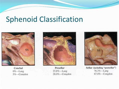 Ppt Principles Of Functional Endoscopic Sinus Surgery Powerpoint