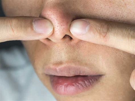 Hot To Easily Get Rid Of Bump On The Nose Top 3 Tips