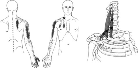 Common Shoulder Diagnoses Musculoskeletal Key