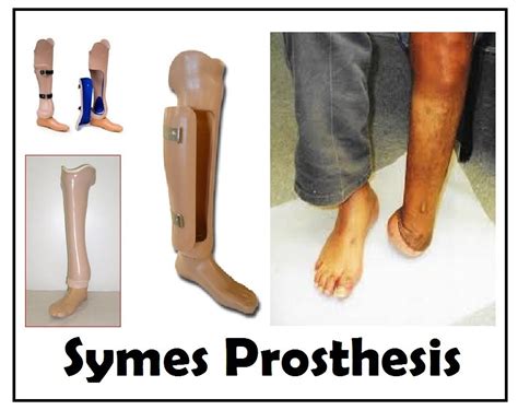 Straight Prosthetic Foot Chopart Symes Prosthesis Ankle