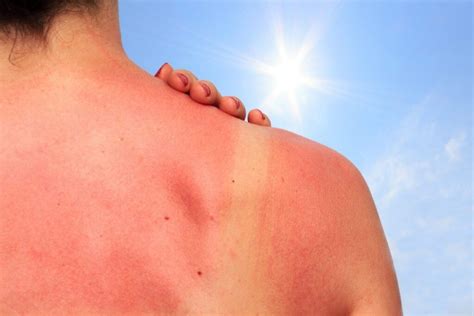 Sun Awareness Week 2020 Prevent Sun Damage Kays Medical