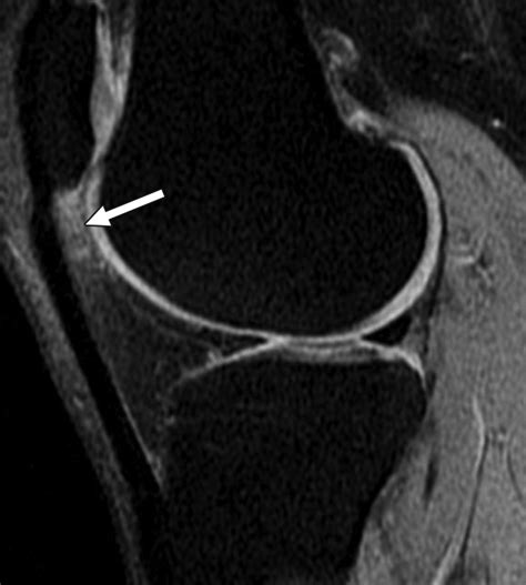 Superolateral Hoffas Fat Pad Edema Association With Patellofemoral