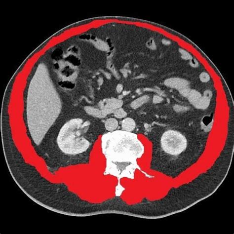Axial Abdominal Ct At The Level Of The Superior Endplate Of The Third