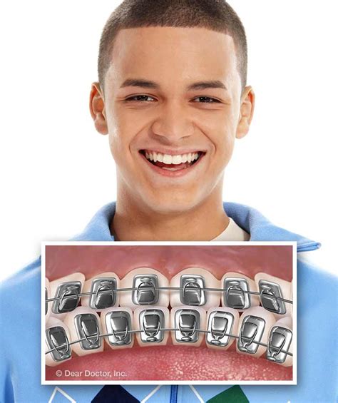 Types Of Braces Orthodontic Specialists Hackettstown New Jersey