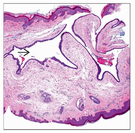 Hidrocystoma Apocrine And Eccrine Basicmedical Key