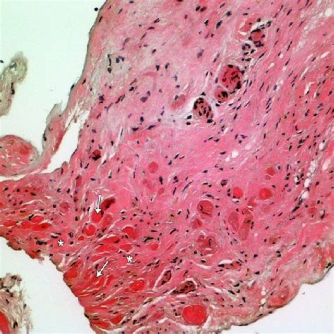 Endomyocardial Biopsy Diffuse Infiltrative Fibrosis Process