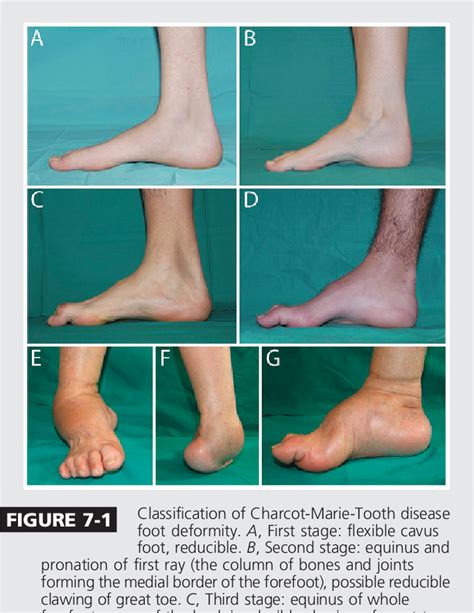 Figure 7 1 From Charcot Marie Tooth Disease And Other Genetic
