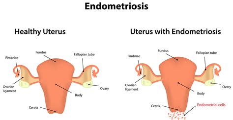 Endometriosis A Top Cause Of Infertility Embry Women S Health