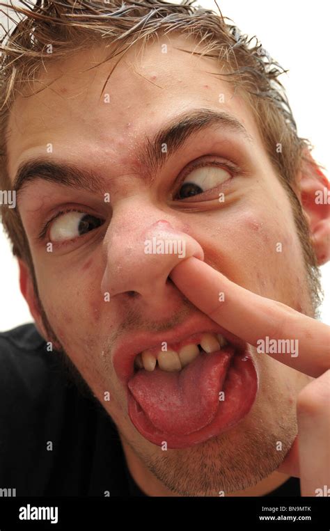 Crazy Wacky Ugly Man With Crooked Teeth And Acne And Veins Above His
