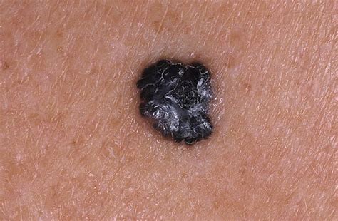 Nodular Melanoma Pictures 27 Photos And Images