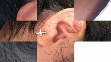 Ear Pimple Cyst Or Whitehead What Is It Youtube
