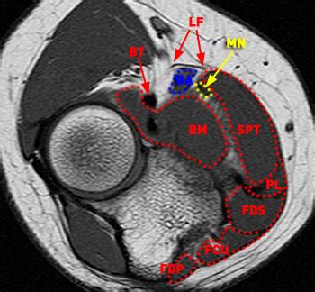 Median Nerve Entrapment - Radsource