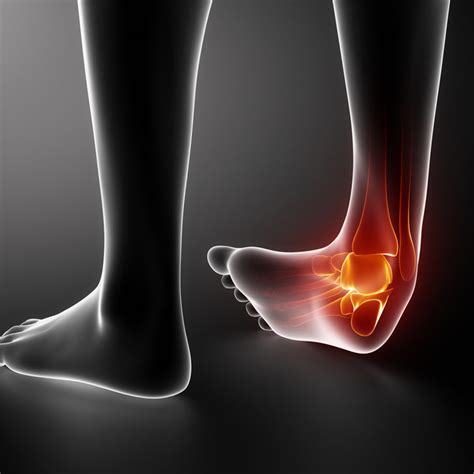 Ankle Injuries Mackay Clinic