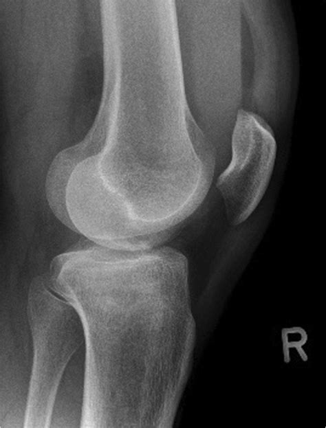 Lateral X Ray Of The Knee Showing An Ao 41 B31 Fracture Type