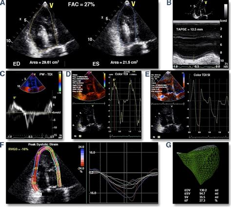 Echocardiographic Assessment Of Right Ventricular Function How To