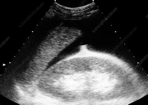 Ascites Of The Liver Ultrasound Scan Stock Image M1080708