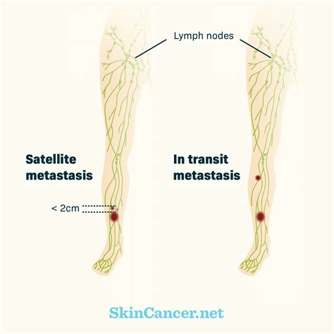 Skin Cancer In Lymph Nodes