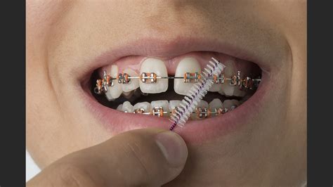Dont Be Deceived By Fake Dental Braces By Uncertified Dentists