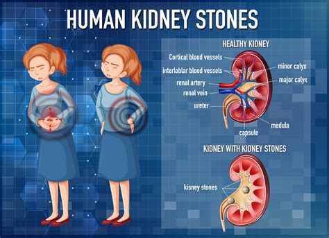 What Are The Locations Of Kidney Stones Kidney Stone Center