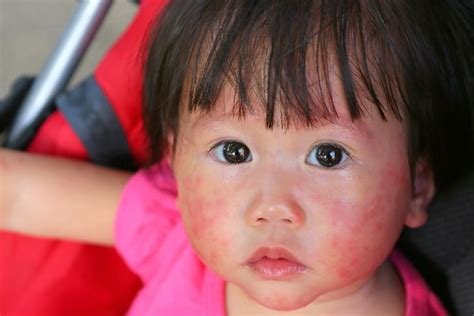 Symptoms Of Fifth Disease In Children And Adults Facty Health