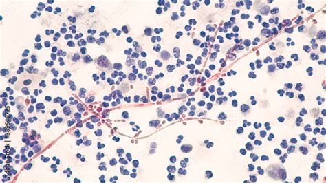 Yeast Infection Budding Yeast And Pseudohyphae Of Candida Albicans Identified In A Urine