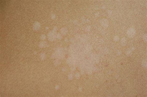 Pityriasis Versicolor Of The Skin Photograph By Dr P Marazziscience